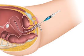 IUI Process